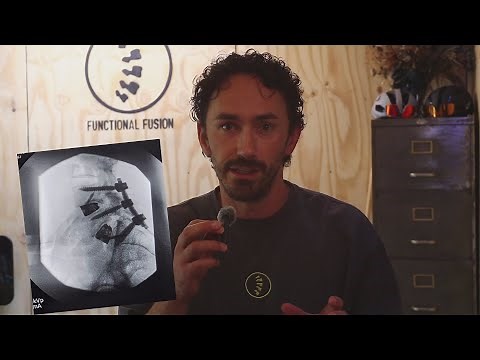 Spinal Fusion Surgery Rehabilitation ---- How I got myself back in action