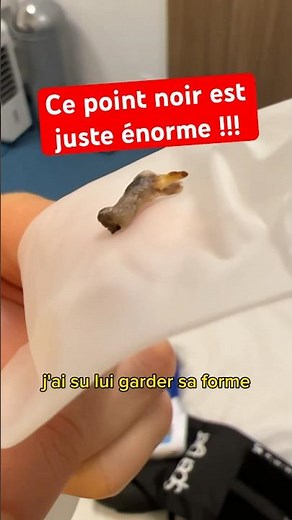 J’ai retiré ce point noir juste ÉNORME à une patiente ! UN COMÉDON SURNATUREL !