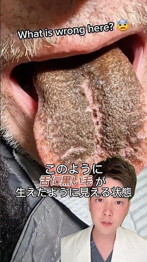 黒毛舌について説明します🦷☝️#歯医者 #おすすめ #fyp #黒毛舌