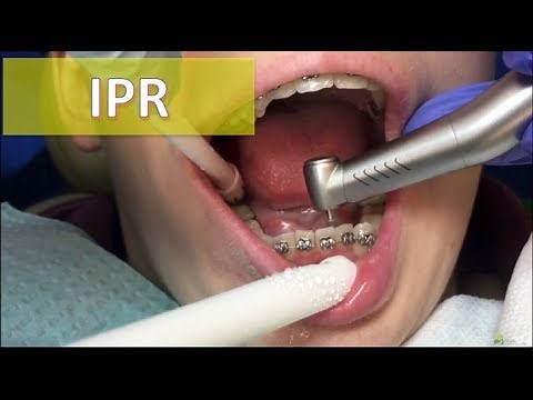 Interproximal reduction - IPR
