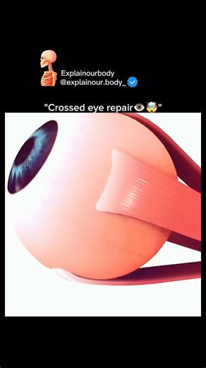 Explainourbody on Instagram: "This looks unbelievable… but it’s REAL eye surgery 😳👁️ Crossed eyes (called Strabismus) happen when eye muscles pull unevenly. During this procedure 👇 🔹 Surgeons carefully adjust tiny eye muscles 🔹 Proper eye alignment is restored 🔹 Brain–eye coordination improves 🔹 Vision, confidence, and quality of life can change forever No lasers. No magic. Just precise medical science saving vision. 👨‍⚕️ One small correction can make a LIFE-CHANGING difference. 👉 Follo
