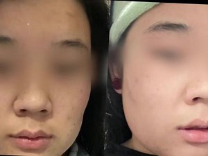 21人实测，毛孔细纹克星安修泽a醇到底有没有用？真实测评，我来看看#护肤#毛孔#测评#真实测评#安修泽紫标精华