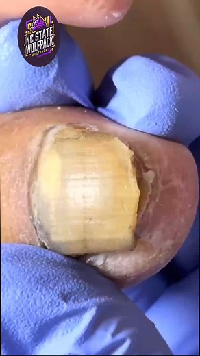 99K views · 1.1K reactions | Simple Steps to Support Thick Toenails Using Safe At-Home Techniques  #WellnessSeniors #FootSupport #FootCareTips | NC State Wolfpack on TheWolfpacker.com | Facebook