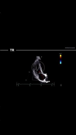 sPAP measurement in #echocardiography #ultrasound