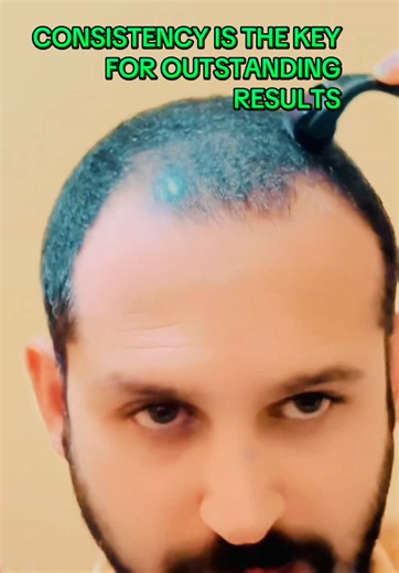 DERMA ROLLER BENEFITS ARE AMAZING 🥰🥰On Overall Skin Transformation:::::🥰 Users have reported significant improvements in their skin's appearance, with some stating that their skin looks better than it did years prior. Microneedling is noted for stimulating the body's natural wound-healing processes, leading to increased collagen and elastin production and helping to reverse and prevent signs of aging. Some users also experience increased radiance after using a derma roller. On Acne Scars & Te