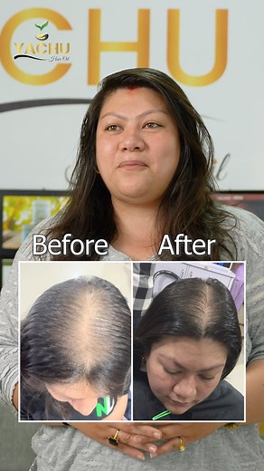 5.8K reactions · 150 shares | 9745671024 #yachu #yachuswoyambhu #follow #yachuhairoil #facebookreel #Nepal #yachuhaircare #NaturalCare #facebookreelsviral | YACHU | Facebook