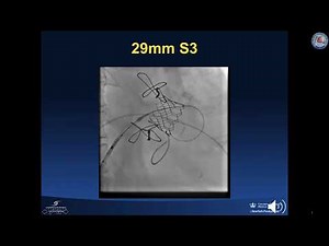 Transcatheter trans-septal mitral valve-in-valve implantation