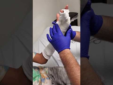 How to make an Ulnar Gutter Cast (fiberglass)