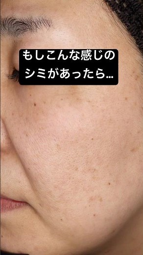 【シミ肝斑】１回で効果の高い治療はこれ