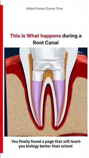 🦷 This is what happens 🔬 during a Root Canal 🧑‍⚕️ | MDCT