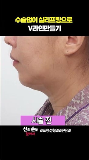 수술없이 실리프팅으로 V라인만들기!! #실리프팅#실리프팅효과#박수연원장@올리고당tv 성형외과전문의 박수연