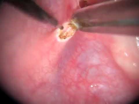 Learning to Perform a Laser Frenectomy