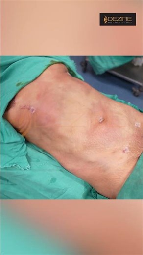 Abdomen Liposuction | Liposuction Result