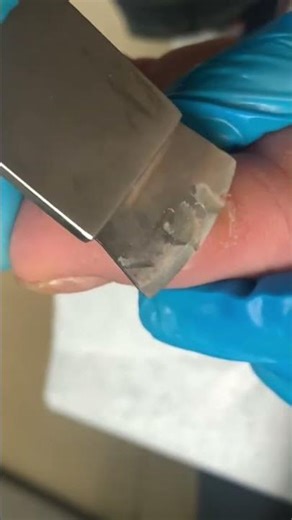 Removel of calluses on toes