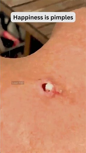 Deep Blackheads, Milia & Whitehead Removal pimple popping New| Big Cystic Acne Extraction #1206 2026