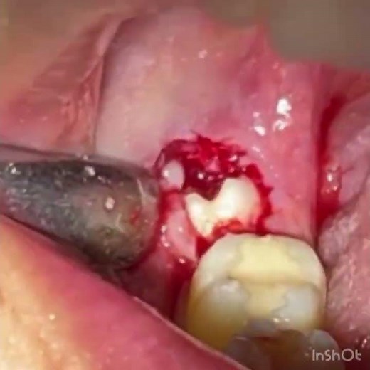 Wisdom tooth removal #wisdomtoothextraction #darshandentalclinic #oralsurgeon