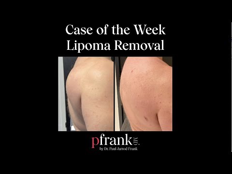 Case of the Week Lipoma Removal