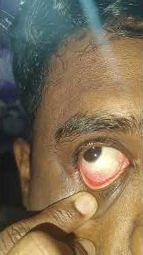 What to do if Someone accidentally poked my eye with his finger #eyes #eyesaccident