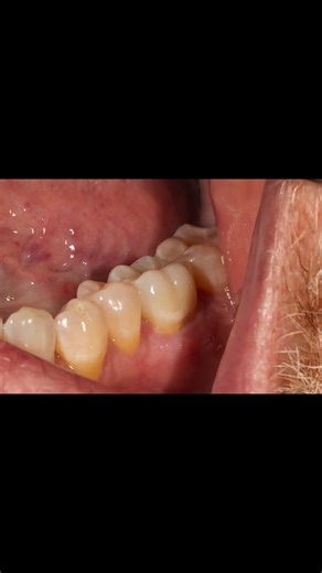 Yuki Momma on Instagram: "One shot technique. Time is money 💰 Thank you Dr @mario.gatti.71 @weston_dsg sending great cases🙏🙏 IPS Ceram Art: The Freedom to Create I will talk to about Ceram Art in LMT Chicago. I will show you demonstration one-shot techniques. Ivoclar Academy in Chicago. Register now🙏🙏🙏🙏 https://lmtmag.com/shows/lmt-lab-day-chicago-2026/seminars?uid=30416_10012_6 #ivoclar #ceramart #zircad #prime #esthetics"