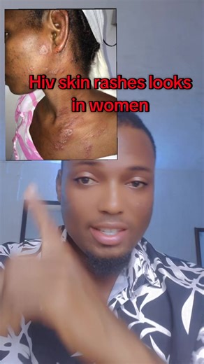 Understanding HIV Skin Rashes in Women