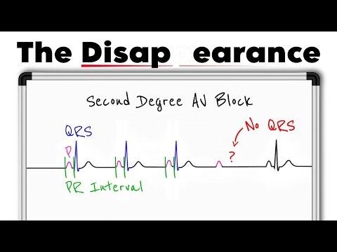 Second-Degree AV Block ECG Explained | Wenckebach vs Mobitz Type II (ECG Made Easy)