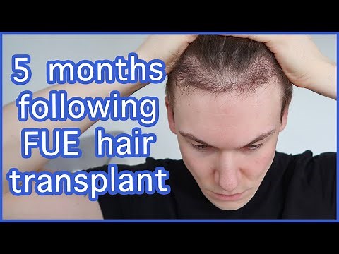 FUE Hair Transplant | Month 5 | FAQ Surgery, Growth, Before & After, Advice | Progress Update