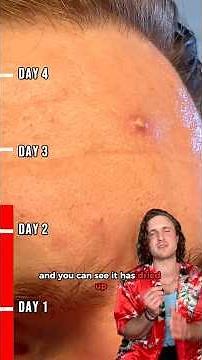 POV: you DON’T pop a pimple 😮😅 Could you? #pimple #acne