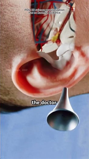 Ear Tube Placement (Tympanostomy Tubes) 3D Animation