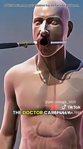 How Incisionless Fundoplication Surgery Is Performed (3D Animation) #endoscopicsurgery#gerd#acidreflux#3dmedicalanimation#medical3danimation