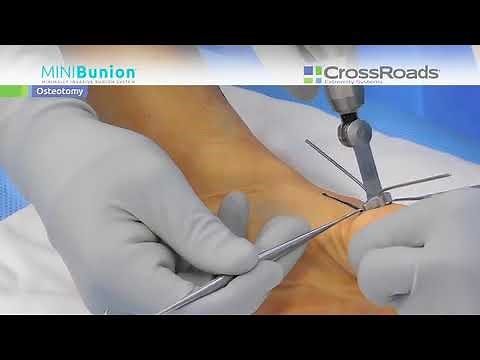 MINIBunion™: MIS Bunion System - Surgical Case - Dr. Bradley Lamm