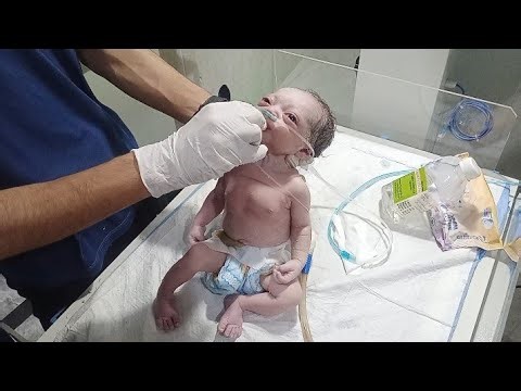 Critical Battle for Life: Newborn with MSL III Undergoes Deep Suction & Resuscitation