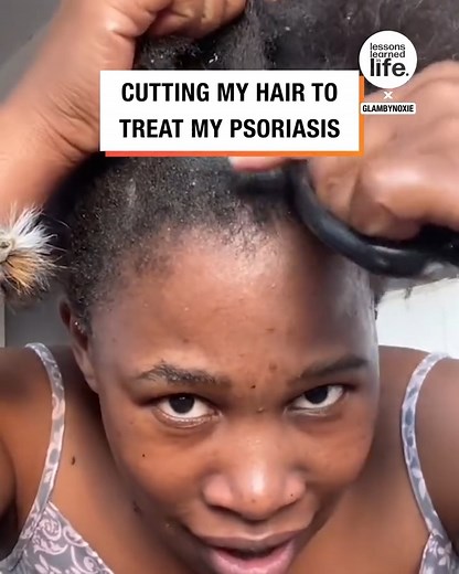 142K views · 618 reactions | 'Cutting my hair to treat my psoriasis' | Lessons Learned In Life | Facebook