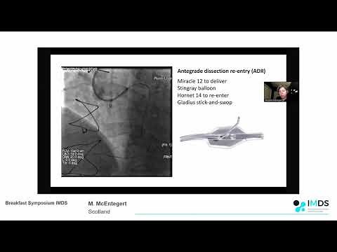 IMDS EuroCTO 2020 - New techniques and versatility of the ReCross dual lumen micro catheter
