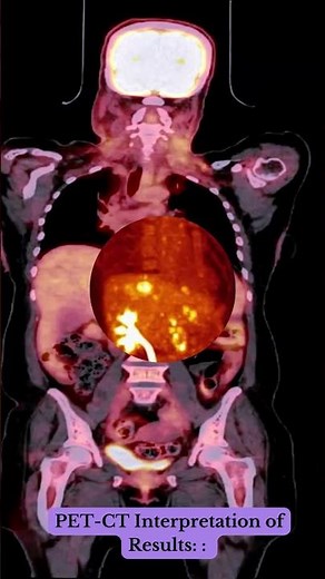 PET-CT - Interpretation of Results #shorts #health