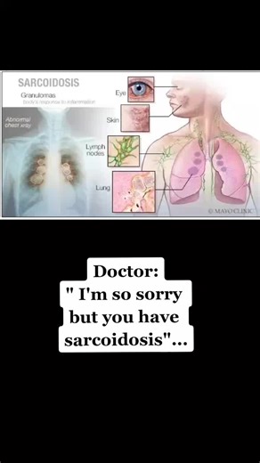 Understanding Sarcoidosis: Diagnosis, Treatment, and Awareness