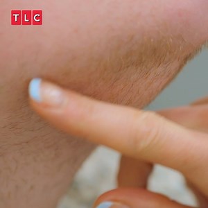 269K views · 2.5K reactions | Woman with PCOS has an amazing transformation after laser hair removal and hormone treatment 喙✨ #TheBadSkinClinic | TLC UK | Facebook