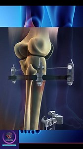 Tibial Fracture and fixation #education #reelsfb | Medical Animation Media