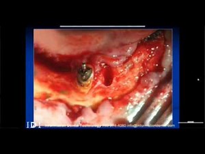 Bone Reduction and Bone Supported Guide for Guided Dental Implant Surgery