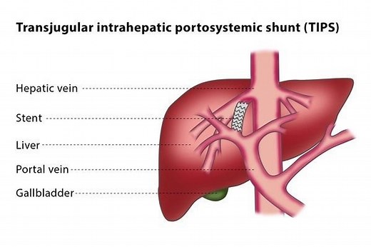 TIPS - Transjugular porto-systemic shunt: what it is, how it works