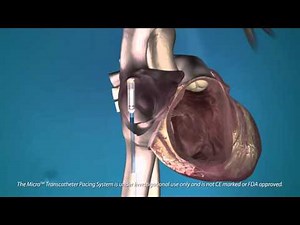 The Medtronic Micra Transcatheter (Pacing System)