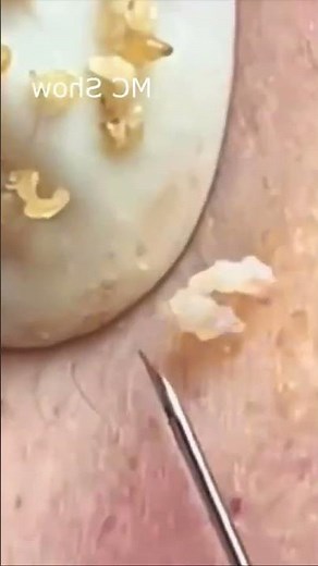 Pimple Popping Blackheads, Acne & Blackheads Removal 43