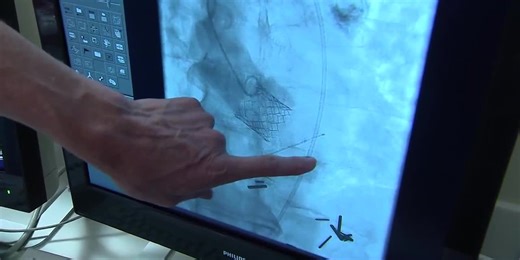 Health Watch: TAVR Procedure