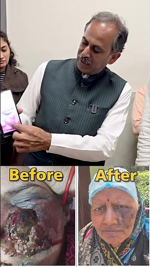 Angiosarcoma Treatment | Aggressive Cancer | Side Effects Of Biopsy | Last Stage Cancer | Hiims