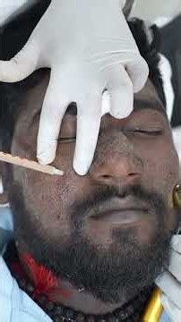 Very Bad Acne Scars removed