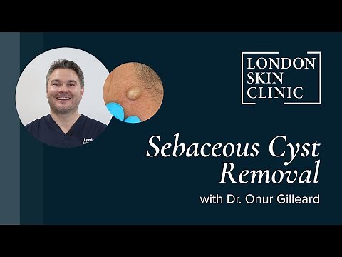 Sebaceous Cyst Removal | Long Lasting Results | Quick Recovery | London Skin Clinic