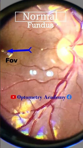Normal fundus | Normal Retina | Smartphone Fundus Videography | Fundus Photography | Short Video 268