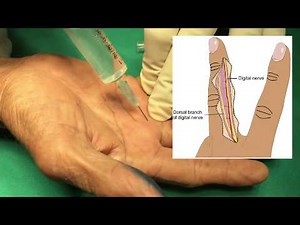 Digital Nerve Block