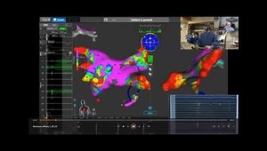 Integrating Mapping and More Versatile PFA Ablation for Tailored Therapy - Affera and Sphere-9 Solution