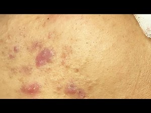 Enlever les points blancs sur la joue de l'homme #2