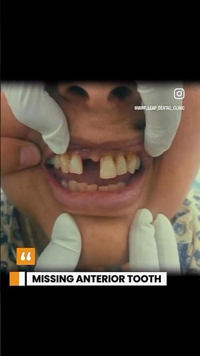 Missing front tooth ?? Here is the solution !